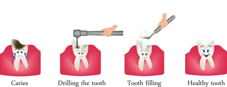 wie die Zahnfüllung erfolgt