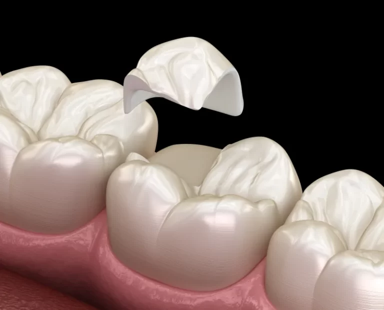 Was bietet Ihnen die CEREC-Zahnbehandlung